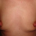 2 months post op.