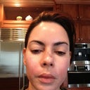One tiny spot to peel on nose- major major improvement,,