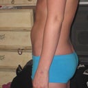 night before surgery. full side!