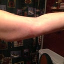 1 week back of arm