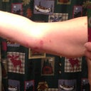 1 week front of arm