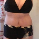 2 weeks today. Compression garment marks are visible but I do have a few stretch marks left because I had a lot below and above belly button. Borrowed daughters bikini as I've seen others here do for pics : ) outside the home that won't be happening lol