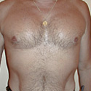 Pec Implants