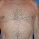 Pec Implants