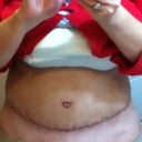 high scar
