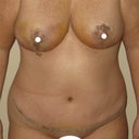 4 days post op - TT and BL