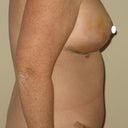 4 days post op - side view
