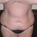 1 week before surgery