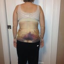 Day 6 post-op