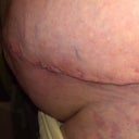 seroma