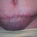 seroma