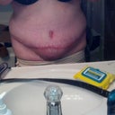 seroma