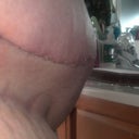 seroma