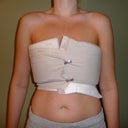 Bandaged up about 30 hours after surgery.  You can see the large foam pads I described for pressure.  And my upper chest is semi Oompa Loompa orange from the antiseptic stuff.  :)