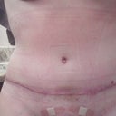 14DPO-- The scar with the steri-strip removed.