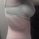 14DPO-- The scar with the steri-strip removed. Starting to look flatter-- but that got more swollen now that I am 17DPO.