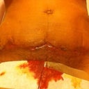 The sutures was cut and removed and the wounds look all like this. After 6 weeks it still leaks mucus and blood