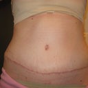 Incision. It gets alittle jagged in the middles, and I dont no y in this pic it looks higher on the left (my right :-) ) maybe I was standing weird?? Still a red ring around my belling button. Im soo stinkin white that I think it's going to take a bit before it's not noticable! lol