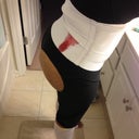 8 hrs post op in garments