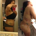 Side by side pre-post op 8 hrs