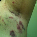 Left pit next morning after shower, quite a bit of bruising