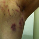Left pit next morning after shower, you can see sporadic bruising