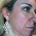 Treatment 3 post Fraxel 7 days, no foundation only eye makeup