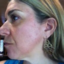 Treatment 3 post Fraxel 7 days, no foundation only eye makeup