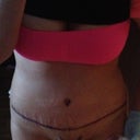 One week post op