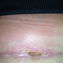 Here is the problem area @ 51 days post op.  It has finally stopped draining, and appears to be almost healed.