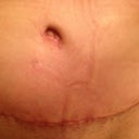 3 1/2 weeks post op