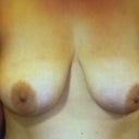 Breasts Before Pic