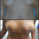 Breast lift before/after 6days PO