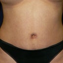 My belly after surgery complements of Dr. F
