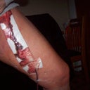Two Days after surgery