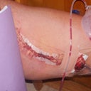 Without outer bandage.