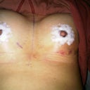 1 day post-op.  The surgical tape is giving rashes so I took them out.  some bruising on the left breast.