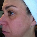 Treatment 4 post Fraxel 8 weeks. No makeup