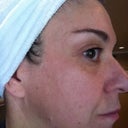 Treatment 4 post Fraxel 8 weeks. No makeup