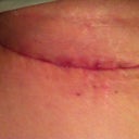 Scar after tape came off 3.5 weeks (tape is now replaced). Pic is upside down - not sure why