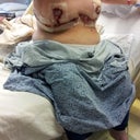 itty bitty titty committee day after surgery
