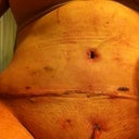 Drain, incision, BB: ouch.