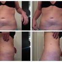 2 Week Post- Close Up Side and Stomach