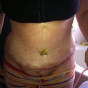Day 2 - first time changing the bandages. YUCK