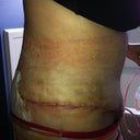 Day 2 - first time changing the bandages