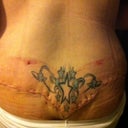 day 10 post op. Incisions go all the way around the back.