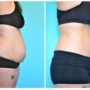 Before and After - 6 months post op