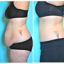 Before and After - 6 months post op