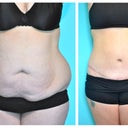 Before and After - 6 months post op