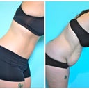 Before and After - 6 months post op